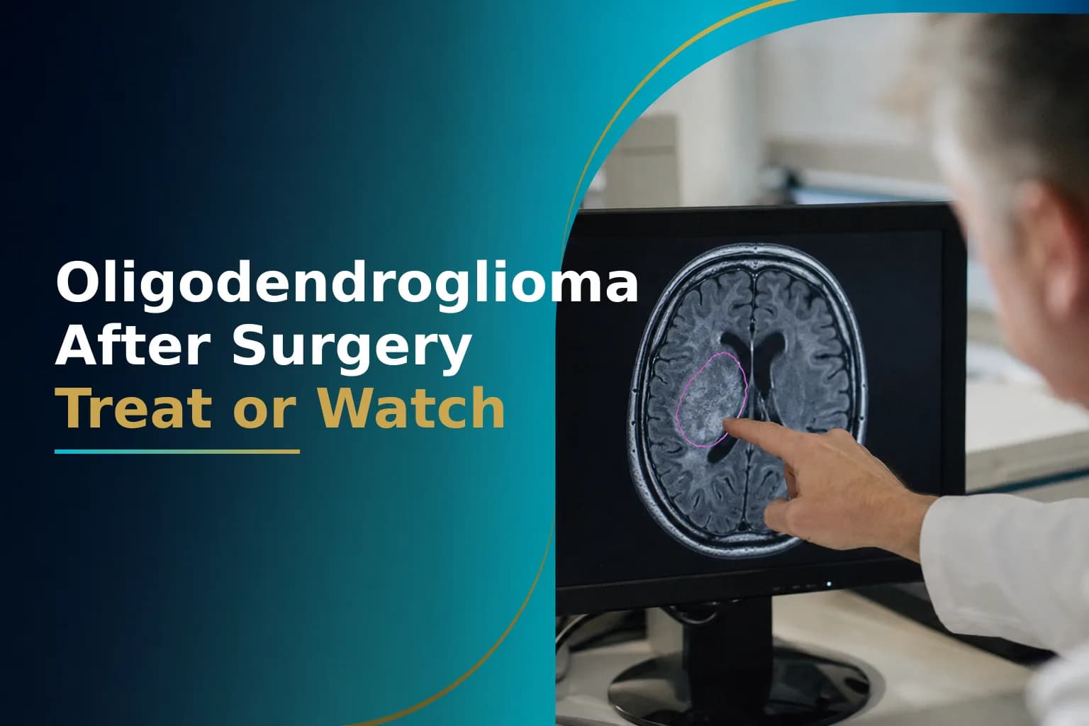 Surgery Alone for Your Oligodendroglioma? When to Expect Adjuvant Radiation and Chemotherapy vs. 'Watch and Wait'