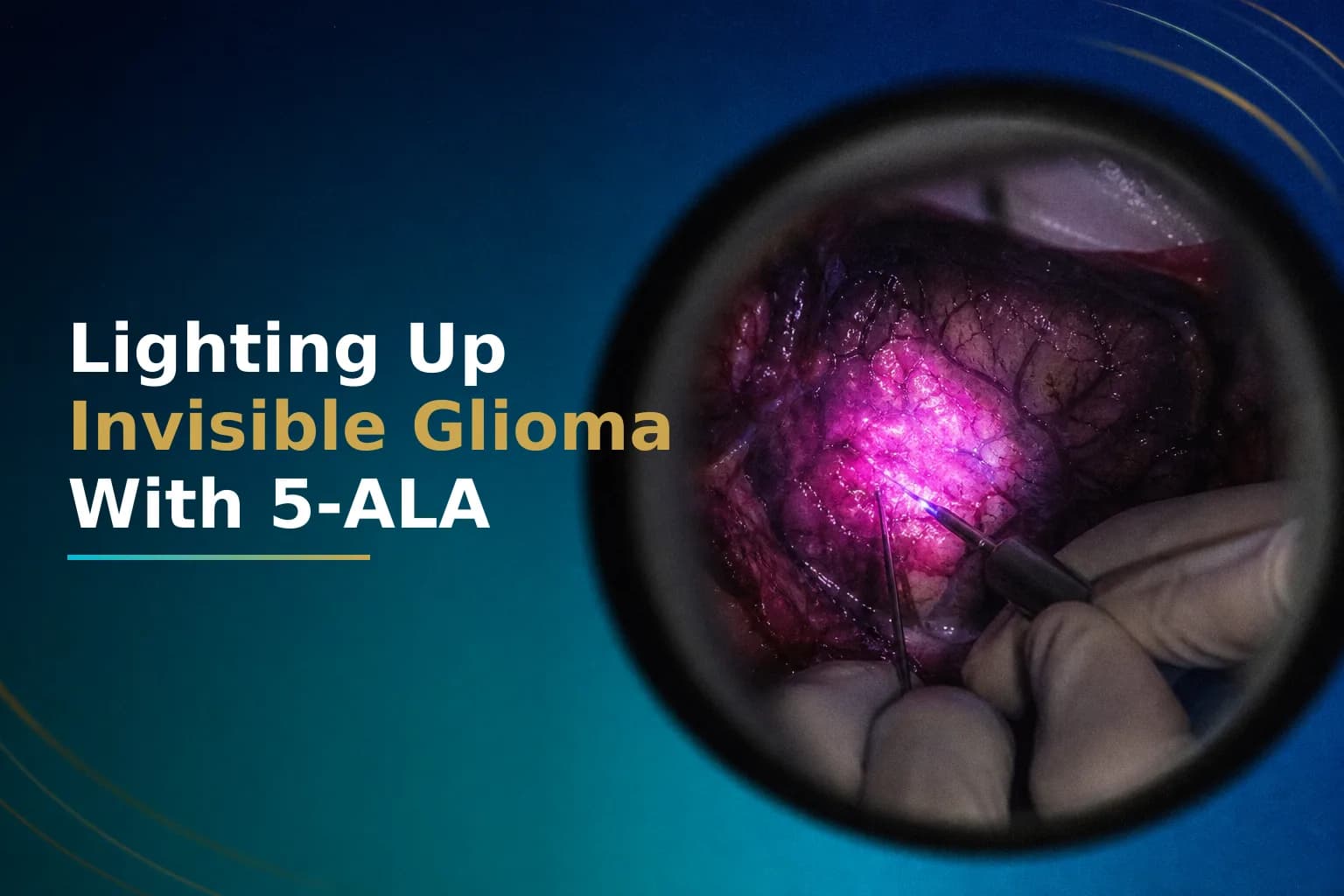 Fluorescence-Guided Surgery for Glioma: How 5-ALA Dye Helps Your Surgeon See Invisible Tumor Cells