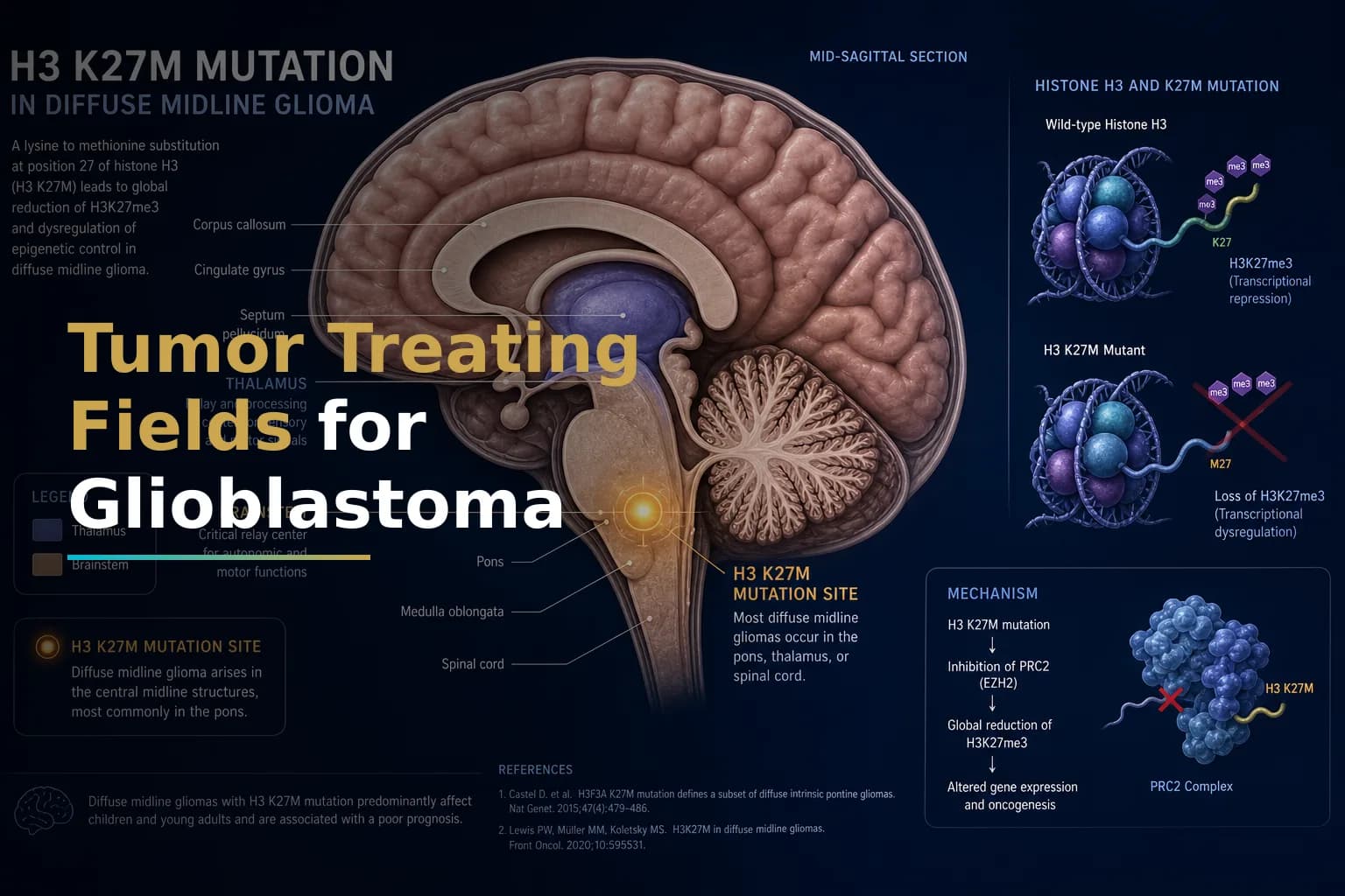 Tumor Treating Fields (TTFields) for Glioblastoma: How the Optune Device Works, Who Qualifies, and What to Expect During Treatment