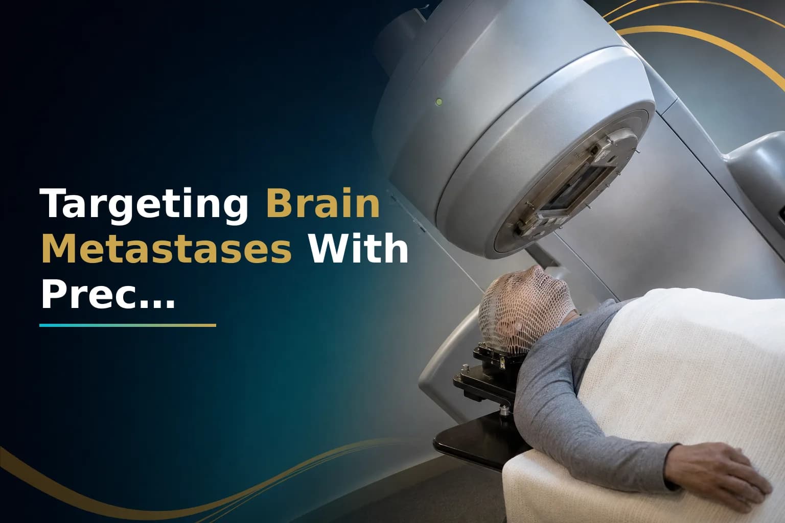 Stereotactic Radiosurgery vs. Whole Brain Radiation for Brain Metastases: Which Approach Is Right for Your Treatment Plan?