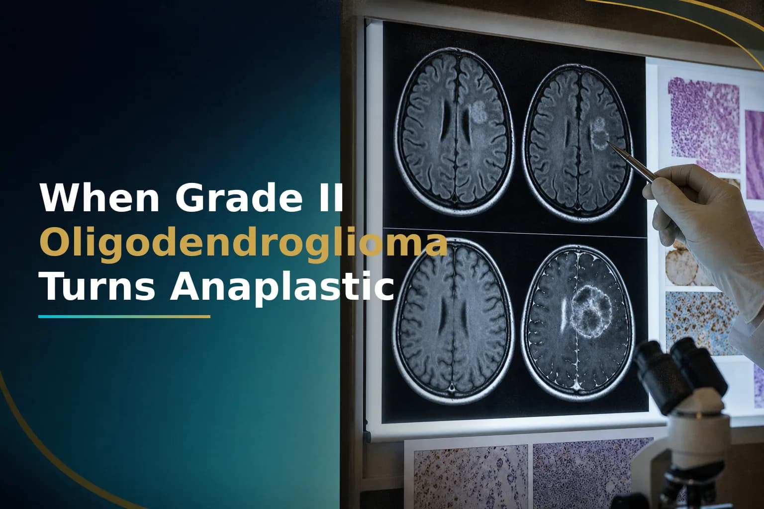 IDH-Mutant Grade II Oligodendroglioma: Why Some Tumors Stay Dormant for Years While Others Transform Into Anaplastic Cancer